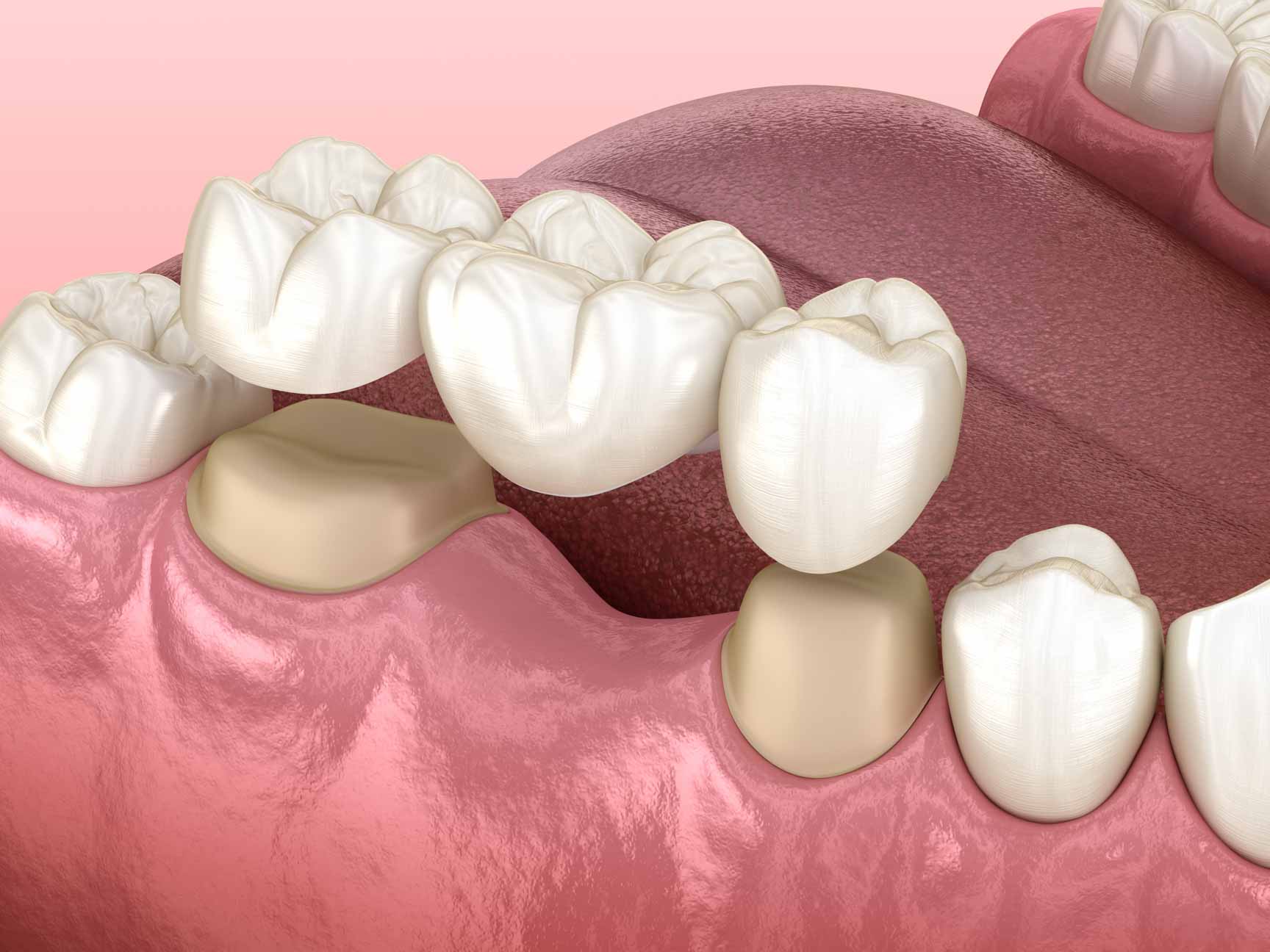 Dental bridges