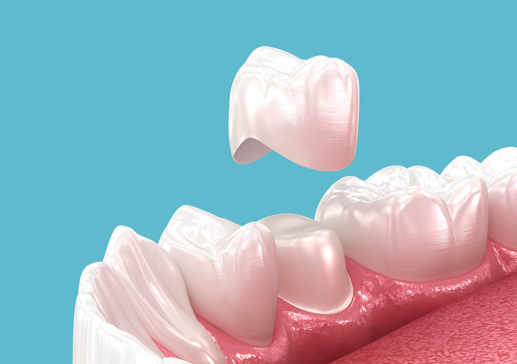Ceramic dental crown
