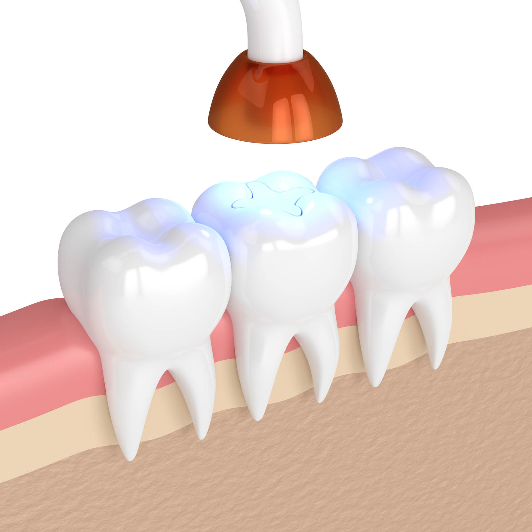 Tooth-colored dental fillings